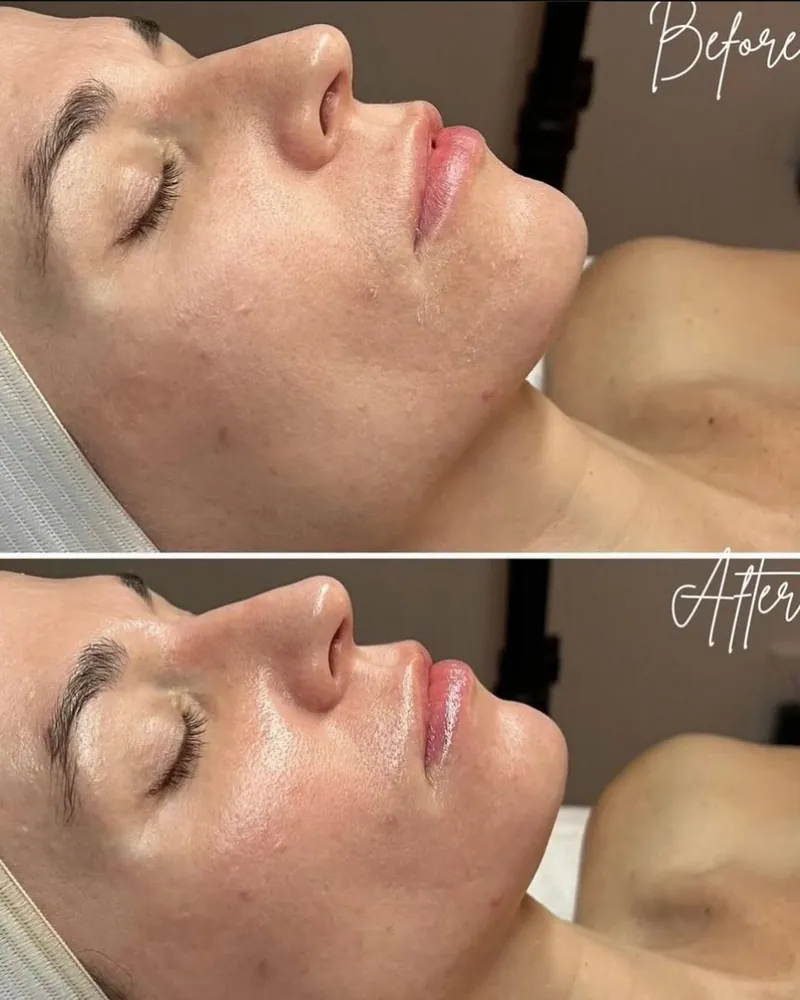 Client skin before and after a treatment series at Loren Skin and Wellness