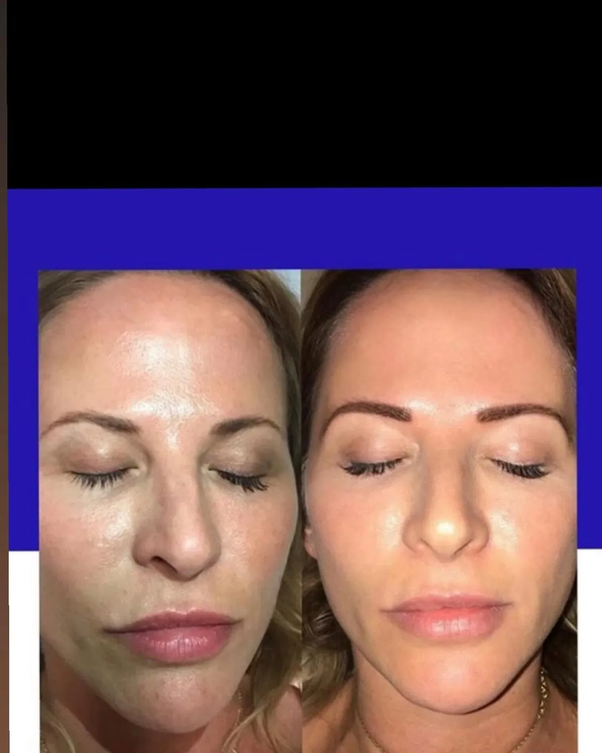Client skin before and after a treatment series at Loren Skin and Wellness